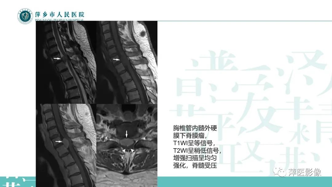 影像PPT - 【PPT】髓外硬膜内肿瘤-10