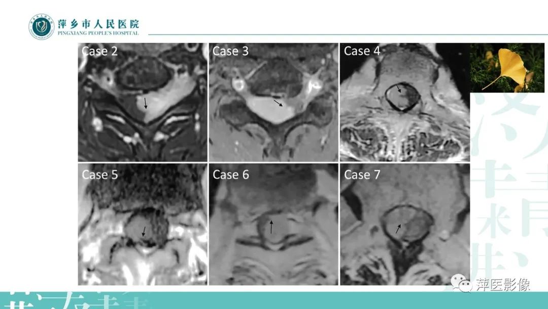 影像PPT - 【PPT】髓外硬膜内肿瘤-12