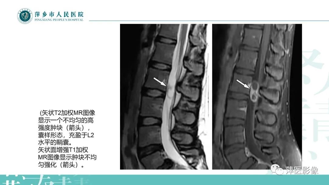 影像PPT - 【PPT】髓外硬膜内肿瘤-14