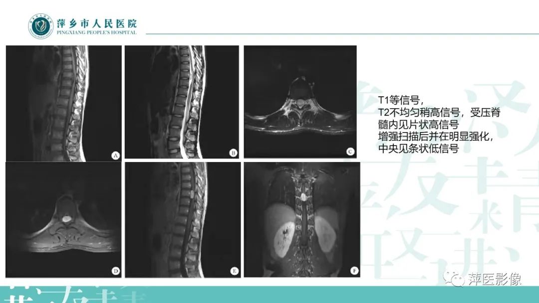影像PPT - 【PPT】髓外硬膜内肿瘤-15
