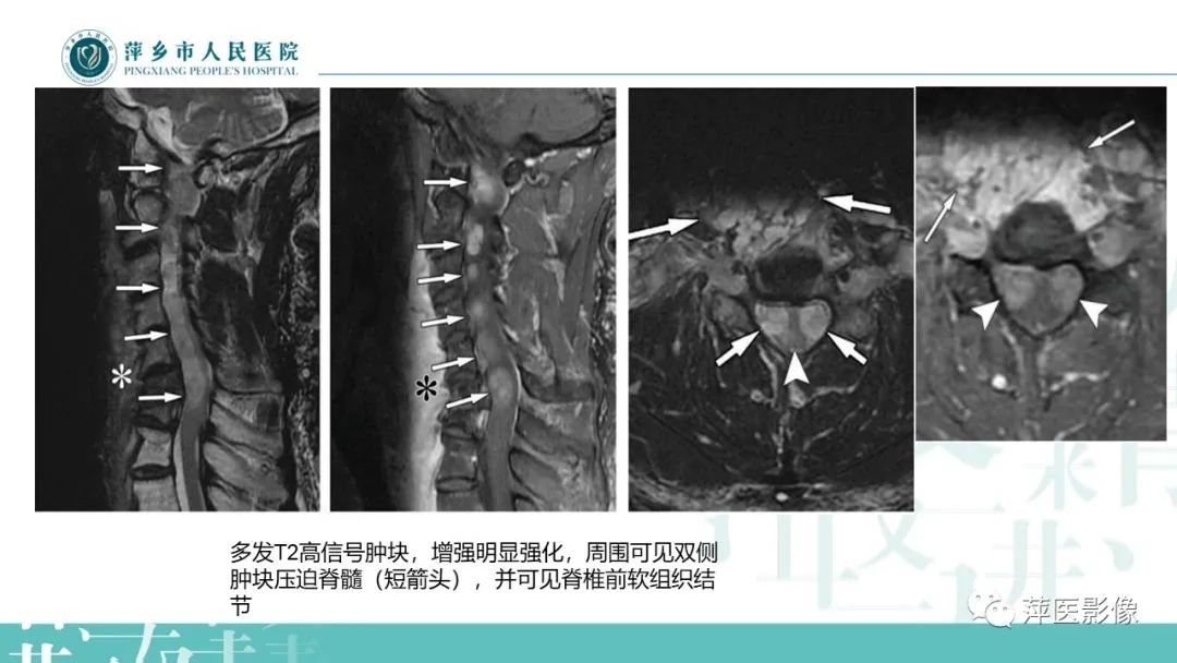 影像PPT - 【PPT】髓外硬膜内肿瘤-19