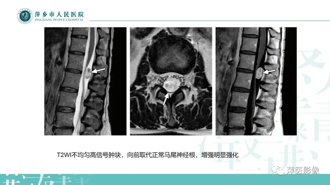 影像PPT - 【PPT】髓外硬膜内肿瘤-21
