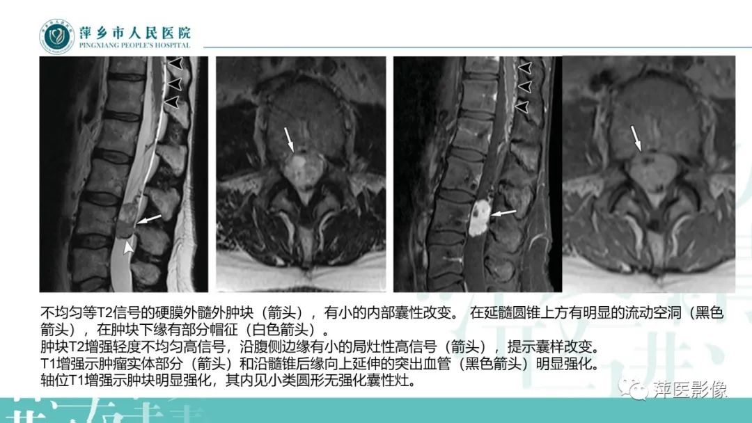 影像PPT - 【PPT】髓外硬膜内肿瘤-23