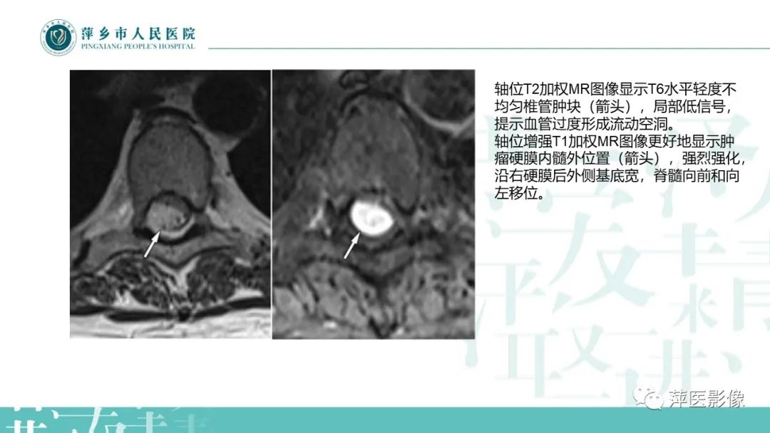 影像PPT - 【PPT】髓外硬膜内肿瘤-25