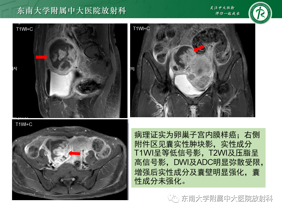 影像PPT - 【PPT】卵巢子宫内膜样癌-3