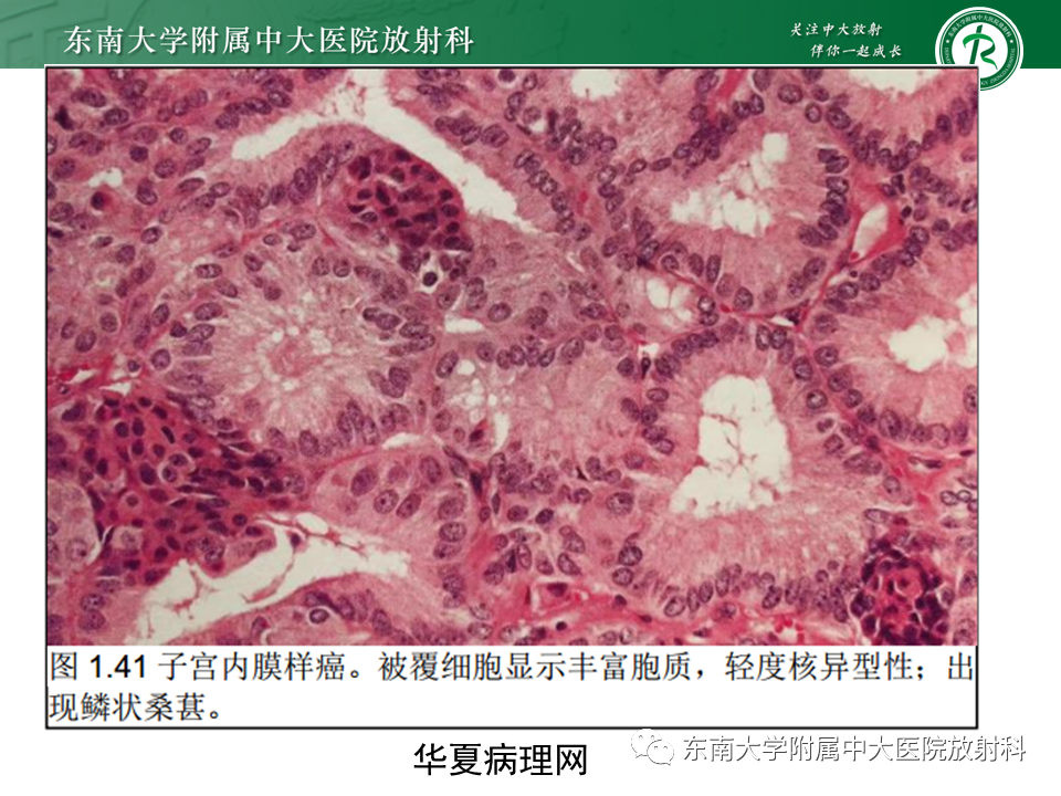 影像PPT - 【PPT】卵巢子宫内膜样癌-17