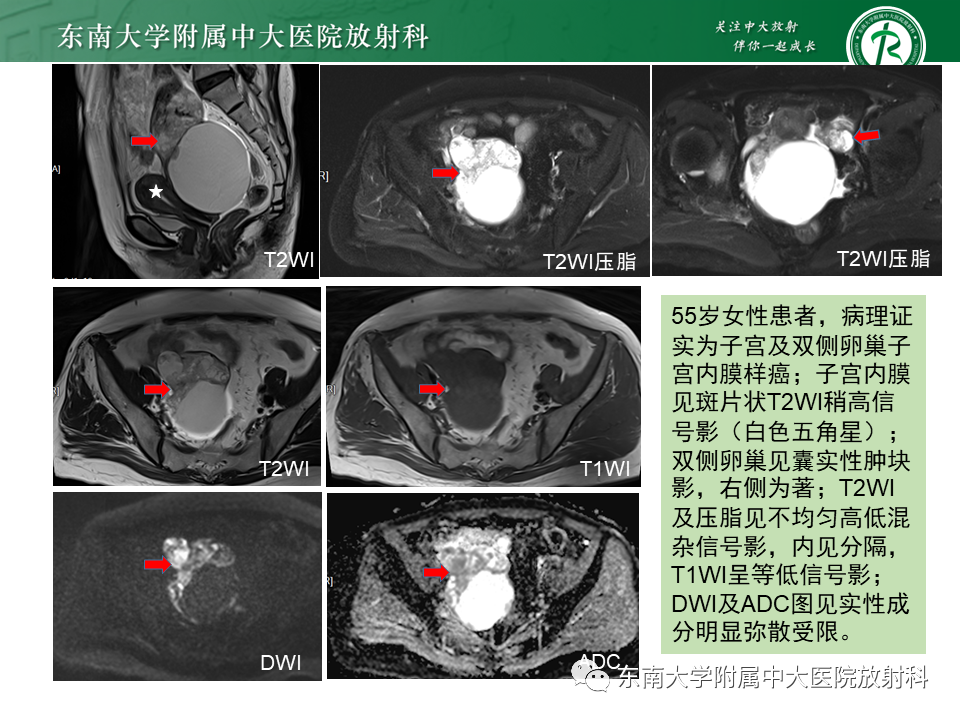 影像PPT - 【PPT】卵巢子宫内膜样癌-20