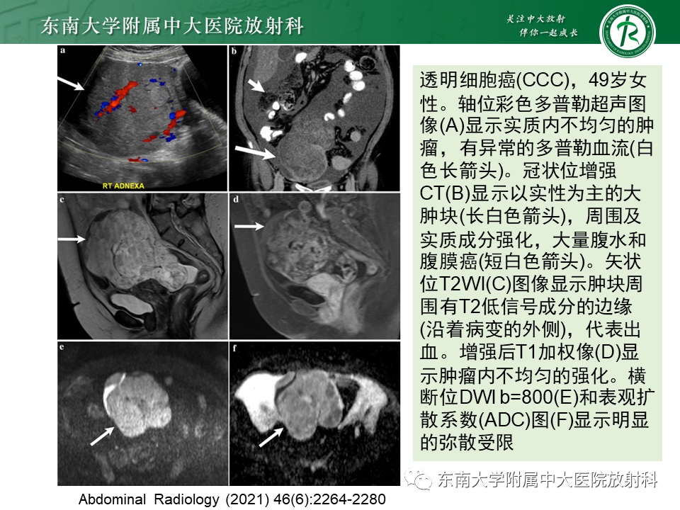 影像PPT - 【PPT】卵巢子宫内膜样癌-24