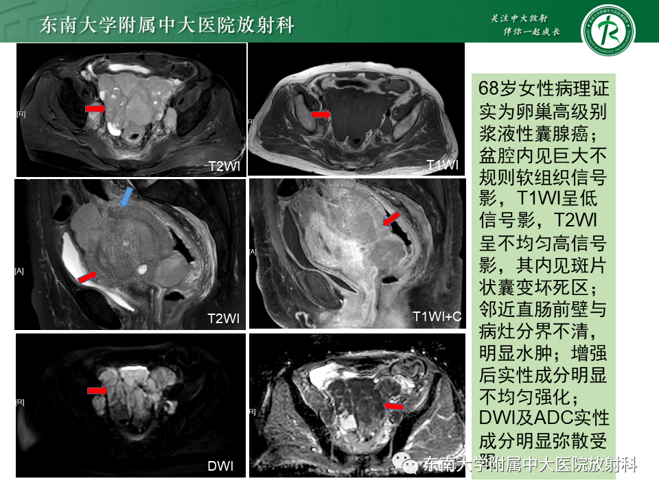 影像PPT - 【PPT】卵巢子宫内膜样癌-28