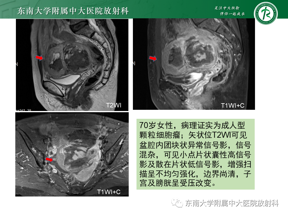 影像PPT - 【PPT】卵巢子宫内膜样癌-30