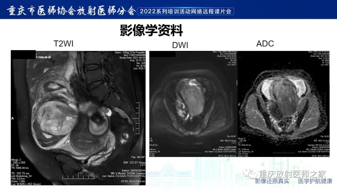 影像PPT - 【病例】子宫内膜样癌1例CT及MR影像-5