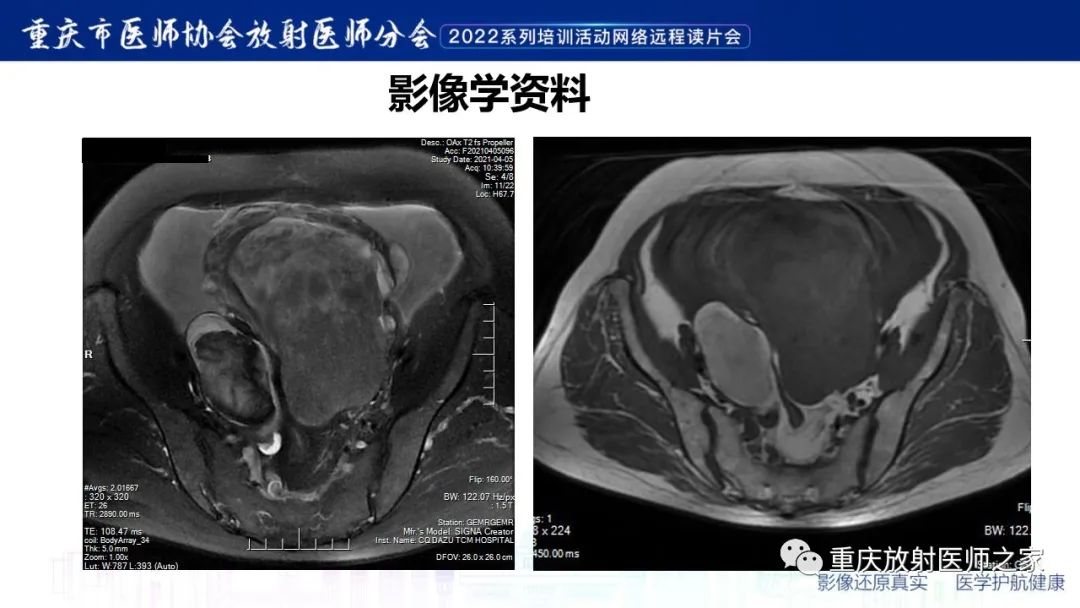 影像PPT - 【病例】子宫内膜样癌1例CT及MR影像-4