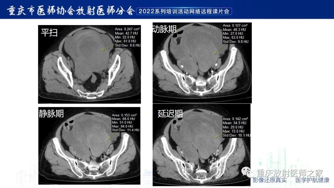 影像PPT - 【病例】子宫内膜样癌1例CT及MR影像-6