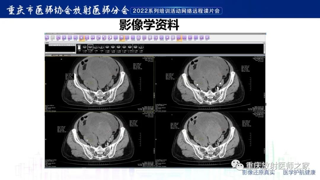 影像PPT - 【病例】子宫内膜样癌1例CT及MR影像-7
