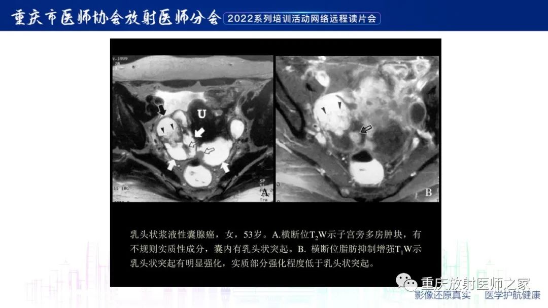 影像PPT - 【病例】子宫内膜样癌1例CT及MR影像-13