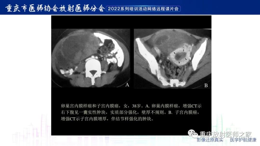 影像PPT - 【病例】子宫内膜样癌1例CT及MR影像-14