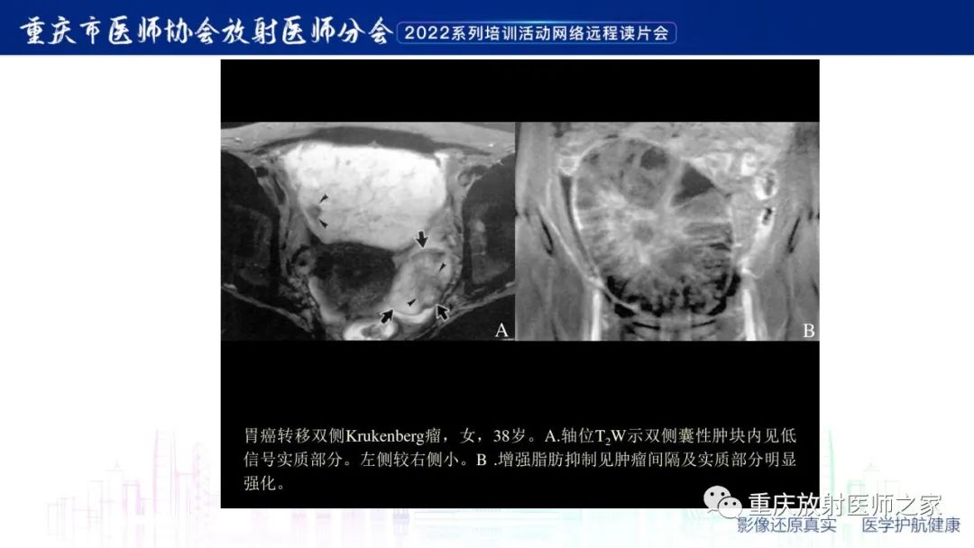 影像PPT - 【病例】子宫内膜样癌1例CT及MR影像-15