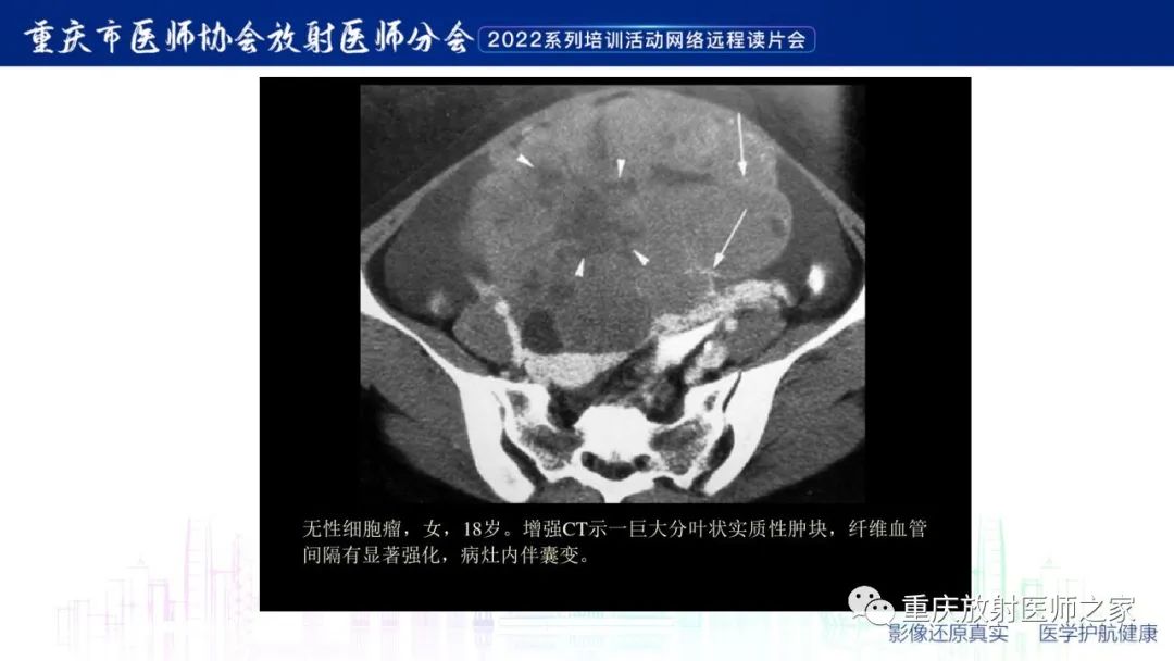 影像PPT - 【病例】子宫内膜样癌1例CT及MR影像-16