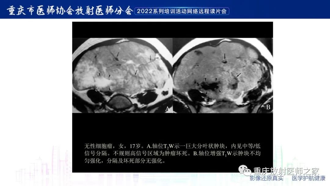 影像PPT - 【病例】子宫内膜样癌1例CT及MR影像-17