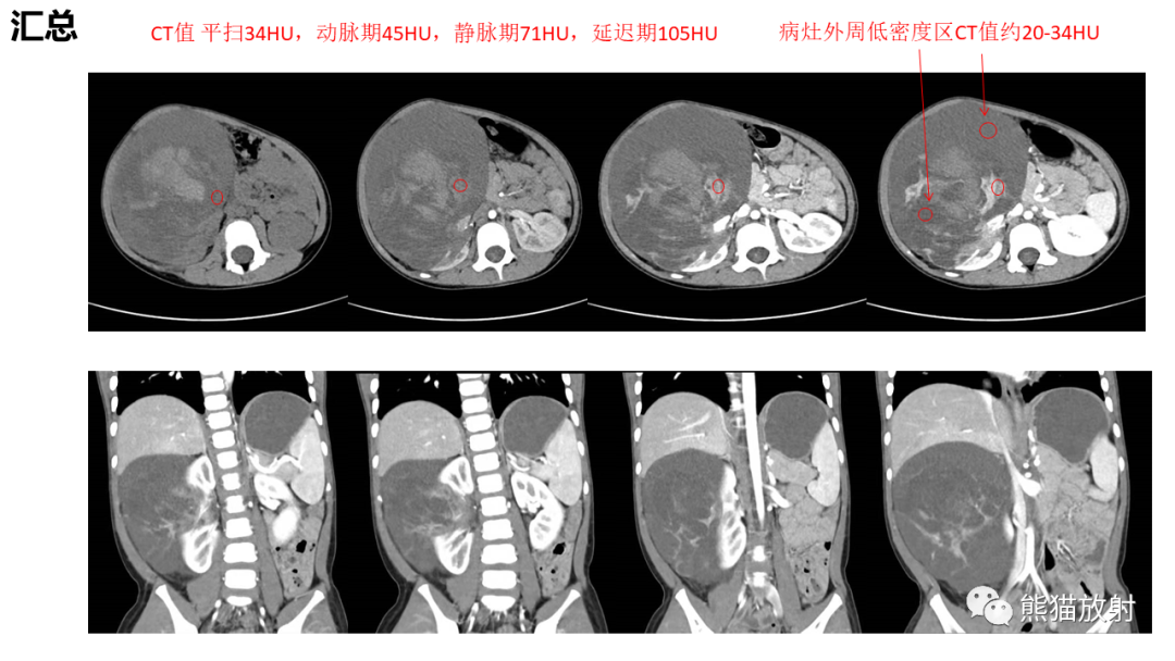 影像PPT - 【病例】肾母细胞瘤 VS 透明细胞肉瘤-6