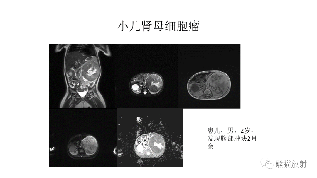 影像PPT - 【病例】肾母细胞瘤 VS 透明细胞肉瘤-12