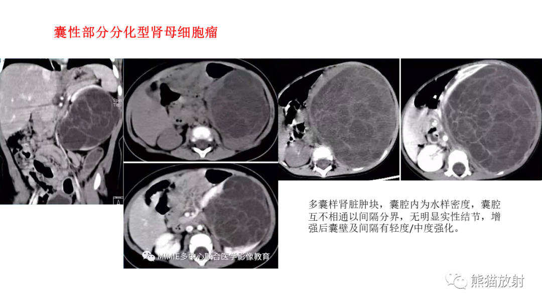 影像PPT - 【病例】肾母细胞瘤 VS 透明细胞肉瘤-14