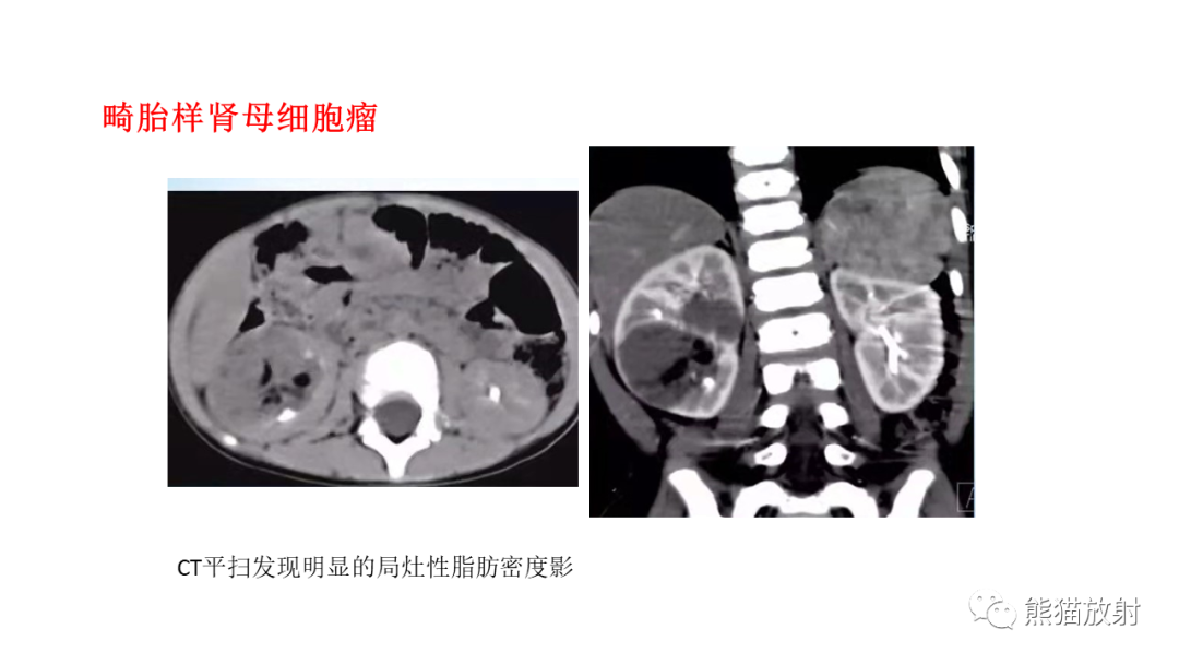 影像PPT - 【病例】肾母细胞瘤 VS 透明细胞肉瘤-15