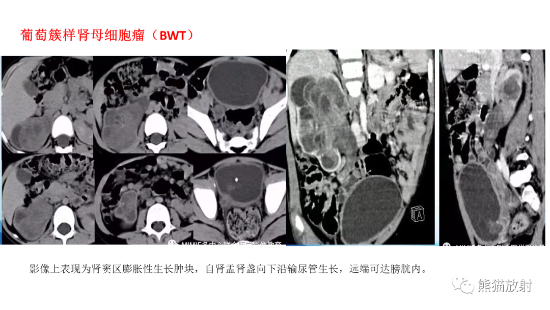 影像PPT - 【病例】肾母细胞瘤 VS 透明细胞肉瘤-16