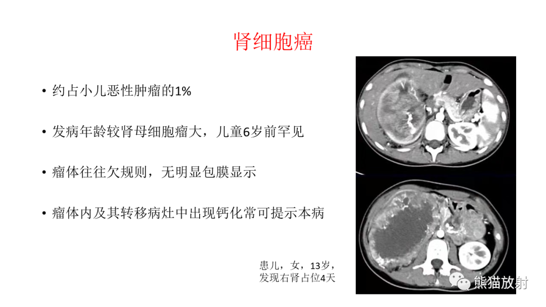 影像PPT - 【病例】肾母细胞瘤 VS 透明细胞肉瘤-19