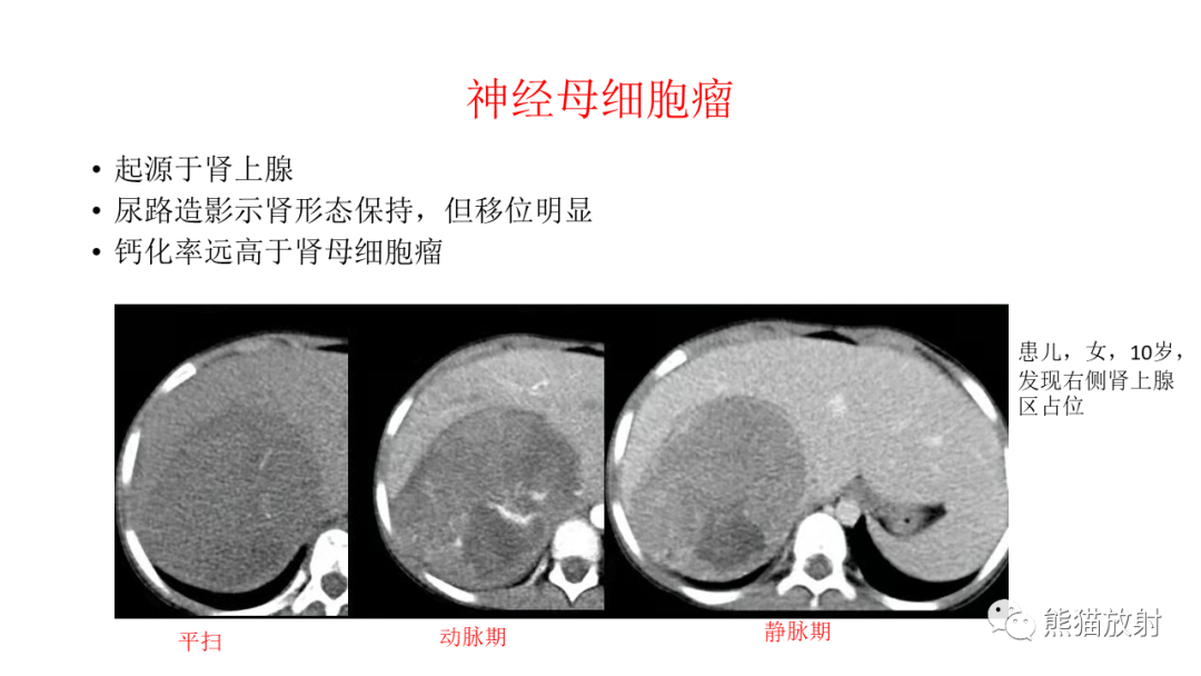 影像PPT - 【病例】肾母细胞瘤 VS 透明细胞肉瘤-20