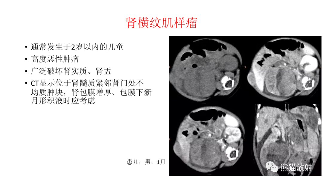 影像PPT - 【病例】肾母细胞瘤 VS 透明细胞肉瘤-21