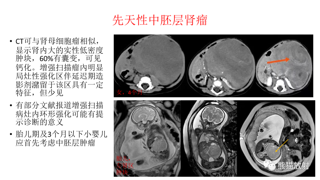 影像PPT - 【病例】肾母细胞瘤 VS 透明细胞肉瘤-22