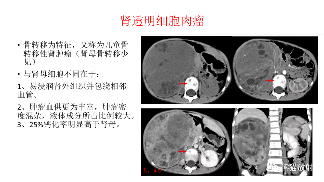 影像PPT - 【病例】肾母细胞瘤 VS 透明细胞肉瘤-23