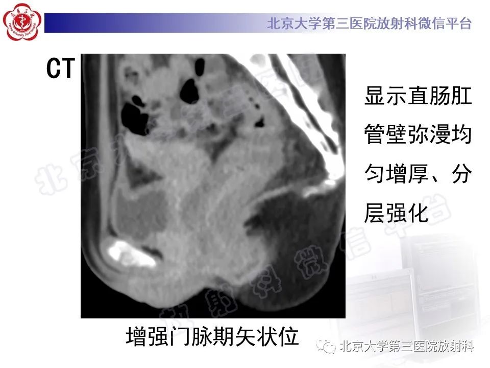 影像PPT - 【PPT】直肠肛管血管畸形-3