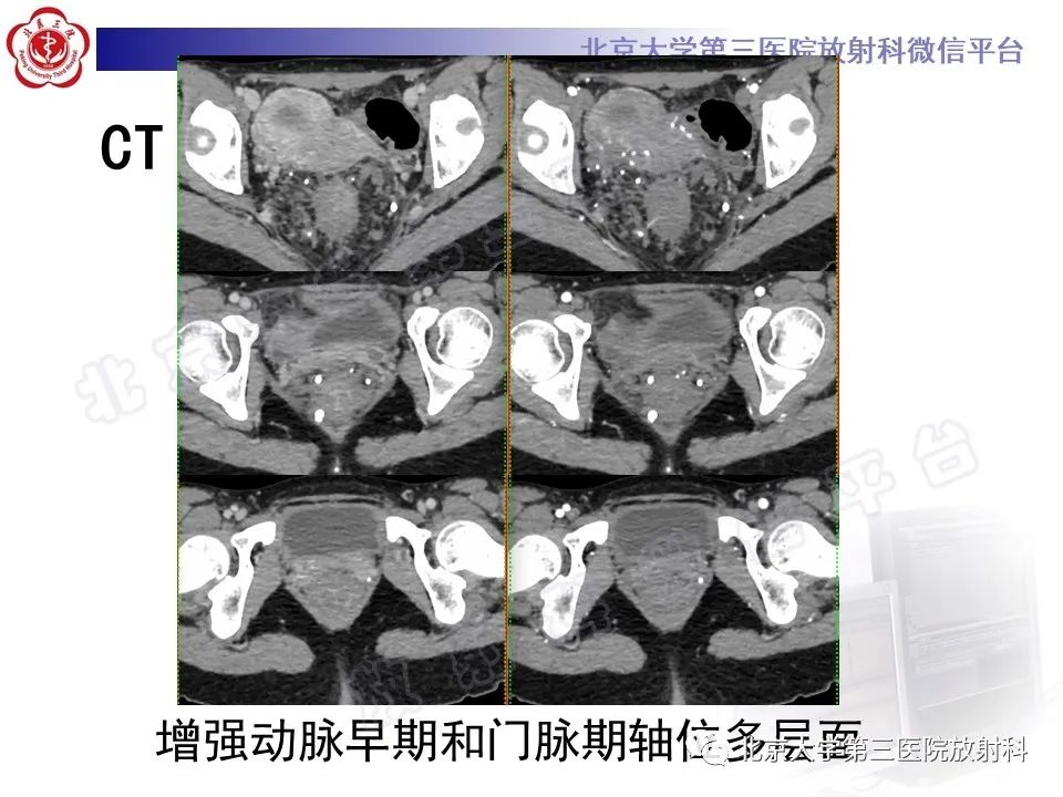 影像PPT - 【PPT】直肠肛管血管畸形-4