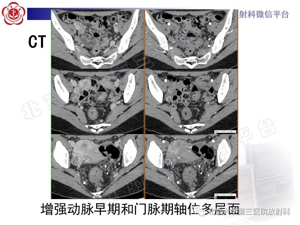 影像PPT - 【PPT】直肠肛管血管畸形-5