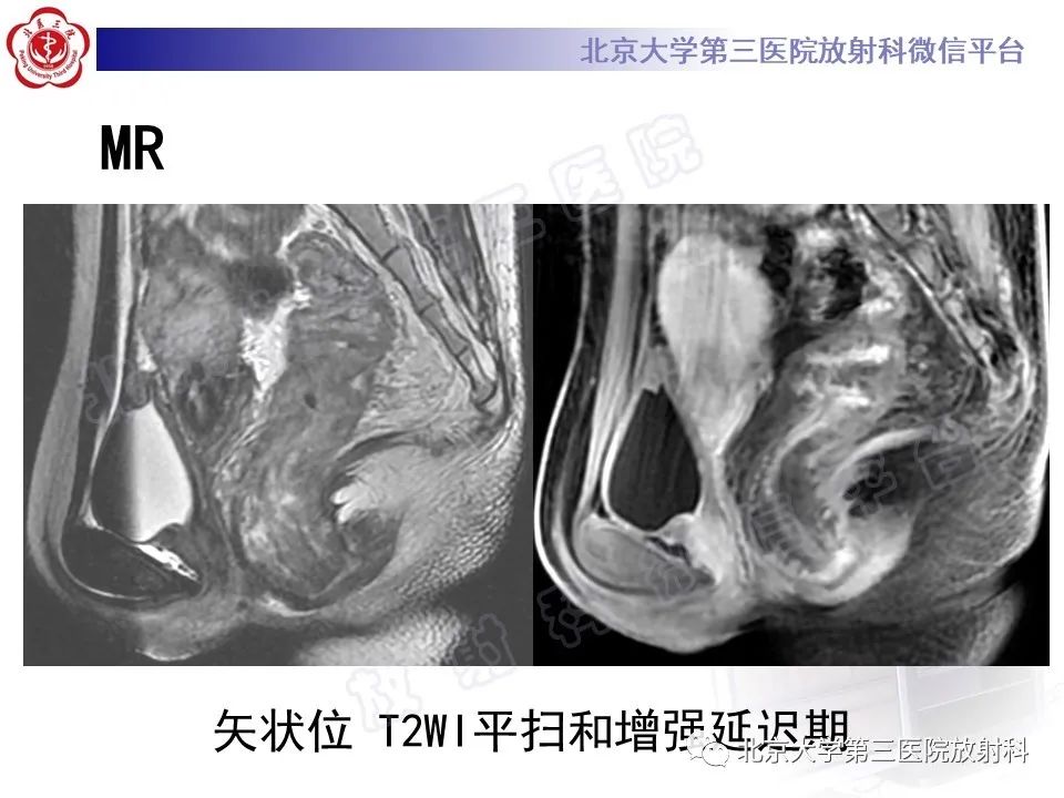 影像PPT - 【PPT】直肠肛管血管畸形-6