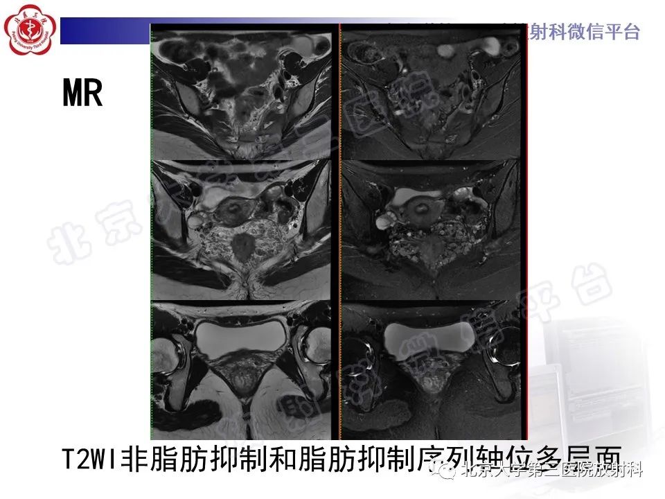 影像PPT - 【PPT】直肠肛管血管畸形-7