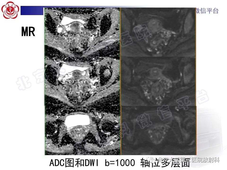 影像PPT - 【PPT】直肠肛管血管畸形-8
