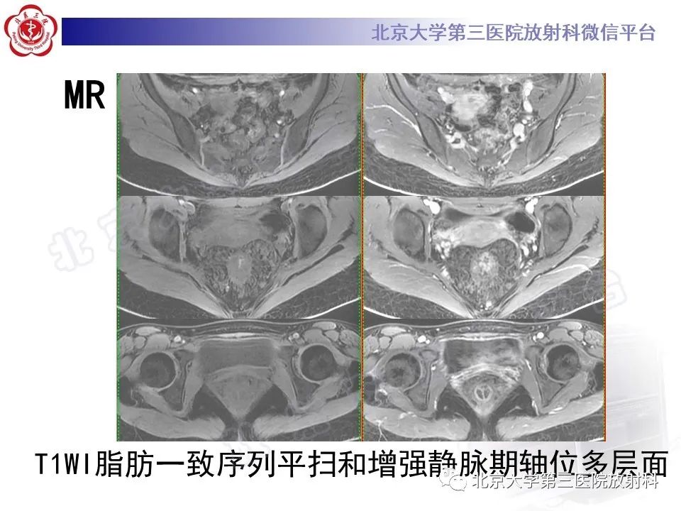 影像PPT - 【PPT】直肠肛管血管畸形-9