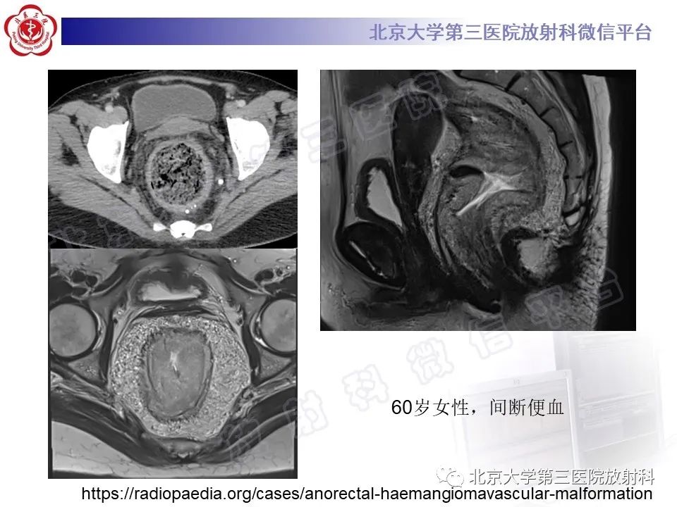 影像PPT - 【PPT】直肠肛管血管畸形-17