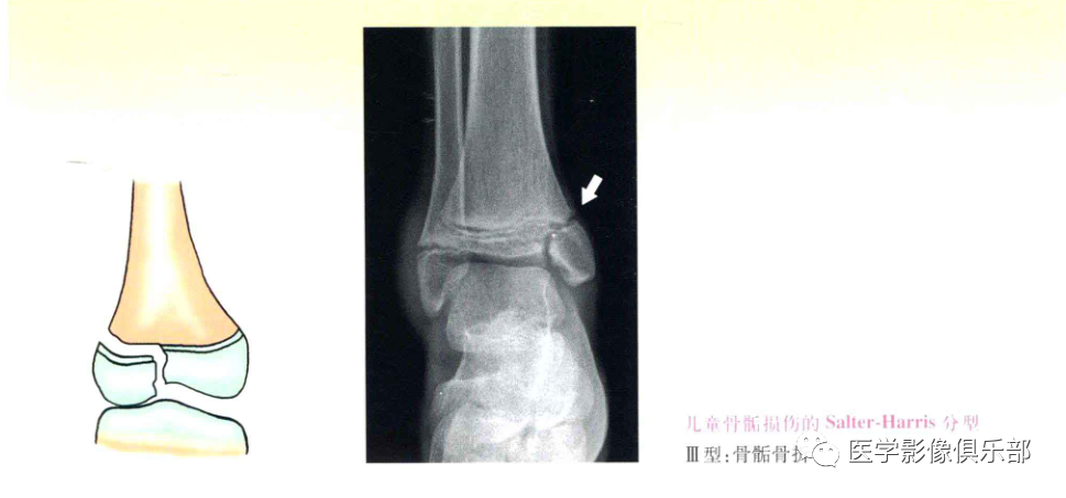 影像PPT - 儿童骨骺损伤/骨折分型-4 影像PPT - 儿童骨骺损伤/骨折分型-4