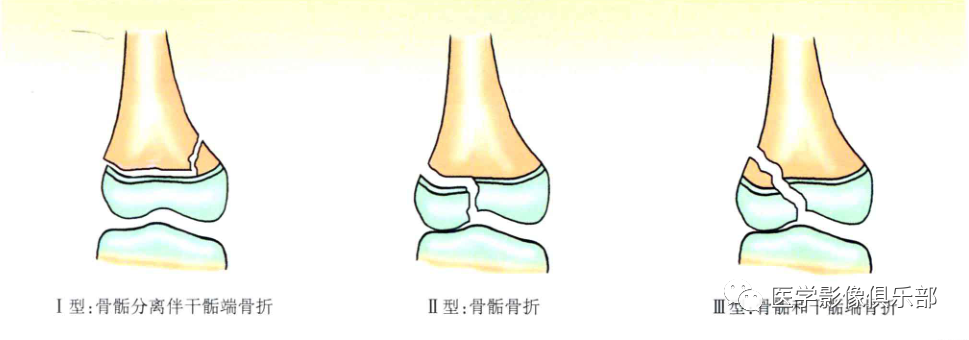 影像PPT - 儿童骨骺损伤/骨折分型-11 影像PPT - 儿童骨骺损伤/骨折分型-11