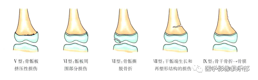 影像PPT - 儿童骨骺损伤/骨折分型-13 影像PPT - 儿童骨骺损伤/骨折分型-13