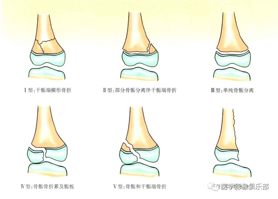 影像PPT - 儿童骨骺损伤/骨折分型-15 影像PPT - 儿童骨骺损伤/骨折分型-15