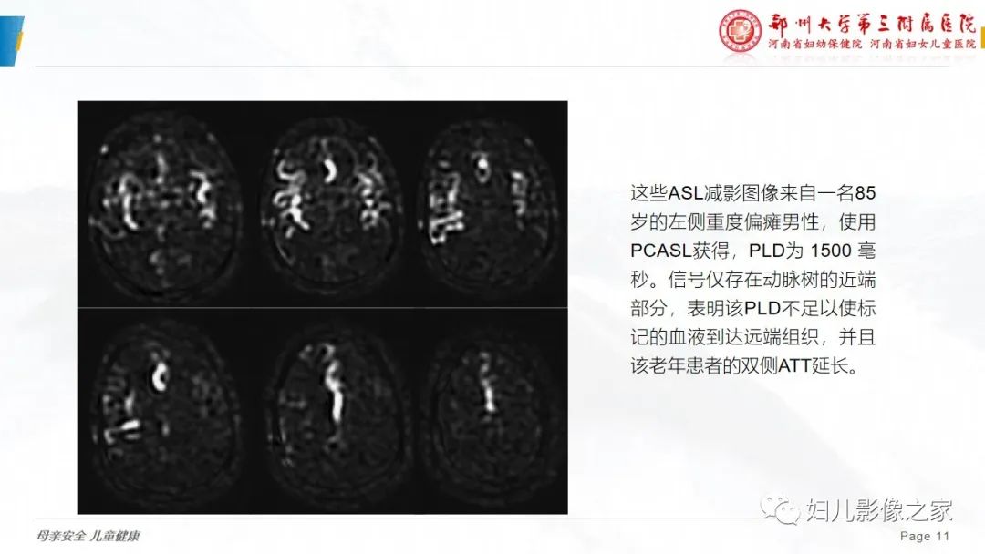影像PPT - 【PPT】ASL技术—专家共识-11
