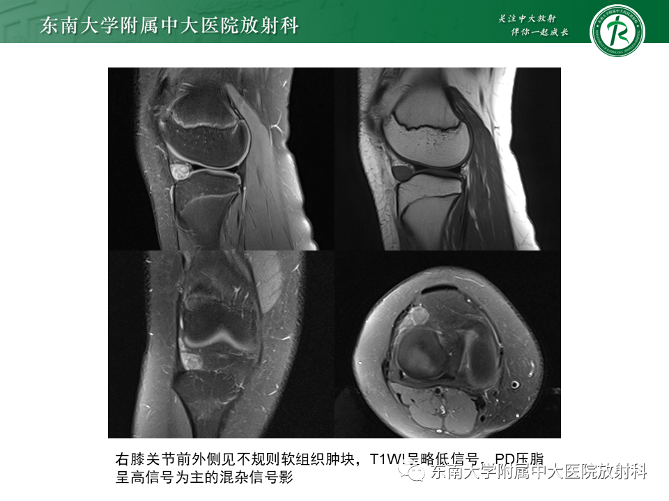 影像PPT - 【PPT】膝关节腱鞘巨细胞瘤-2