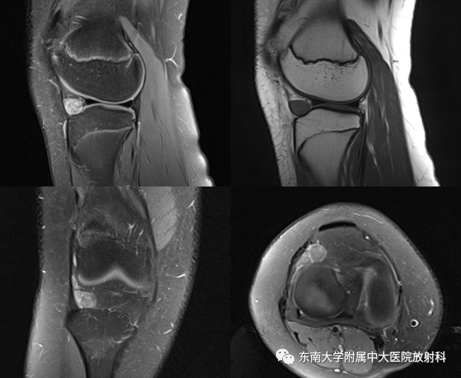 影像PPT - 【PPT】膝关节腱鞘巨细胞瘤-1