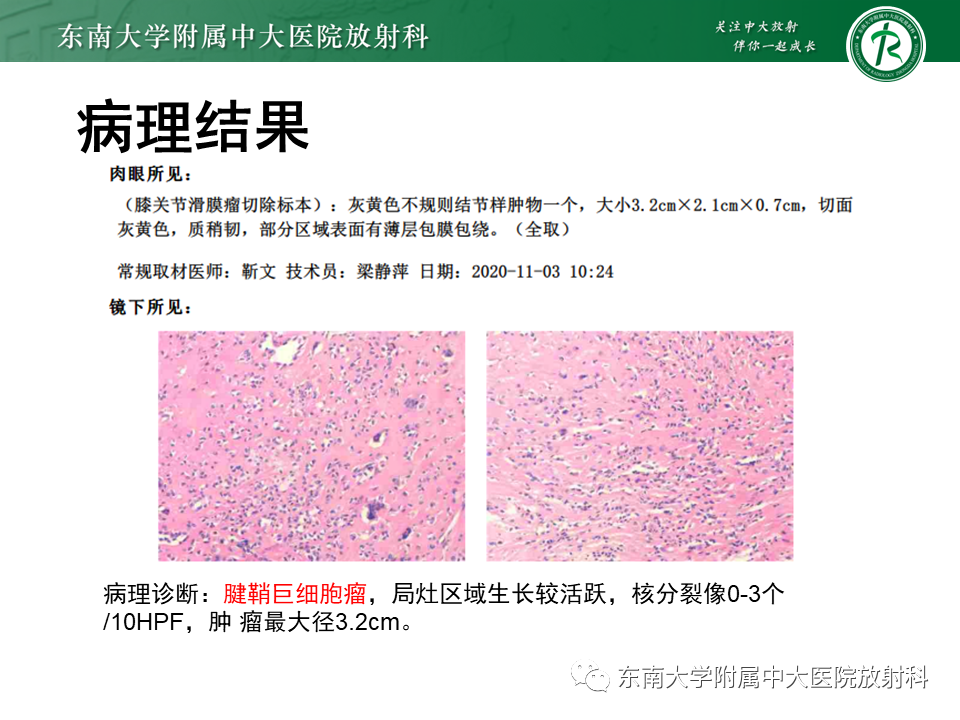 影像PPT - 【PPT】膝关节腱鞘巨细胞瘤-3