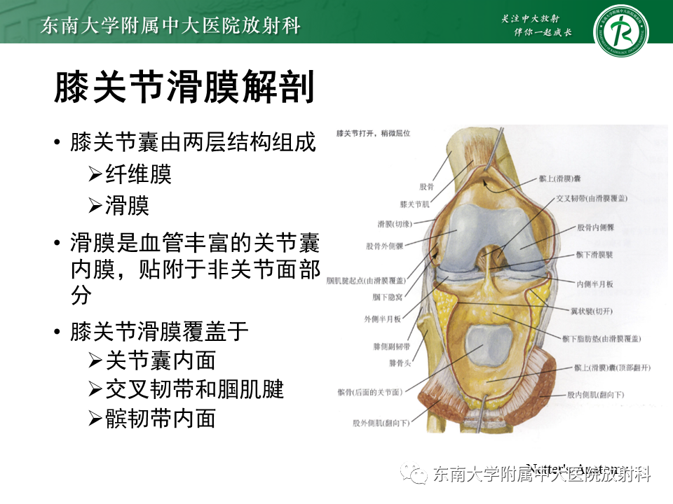 影像PPT - 【PPT】膝关节腱鞘巨细胞瘤-6